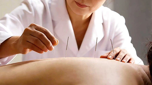 Acupuncture Treatment 